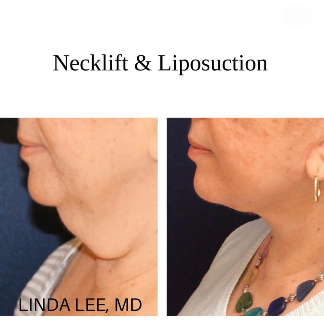 Necklift _ Liposuction 2b side