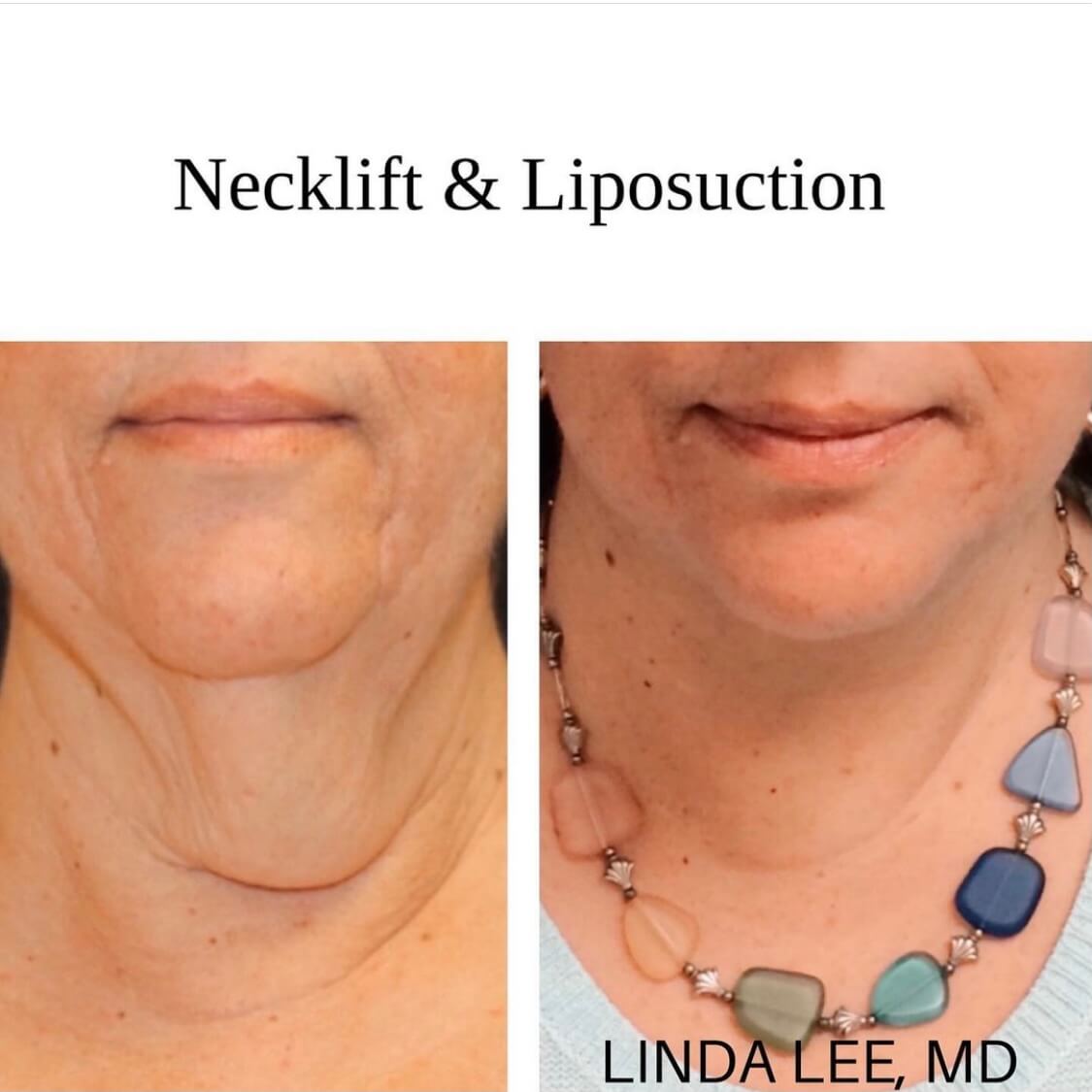 Necklift _ liposuction 2