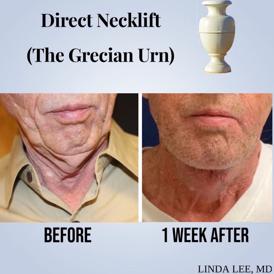 Necklift and direct grecian 6